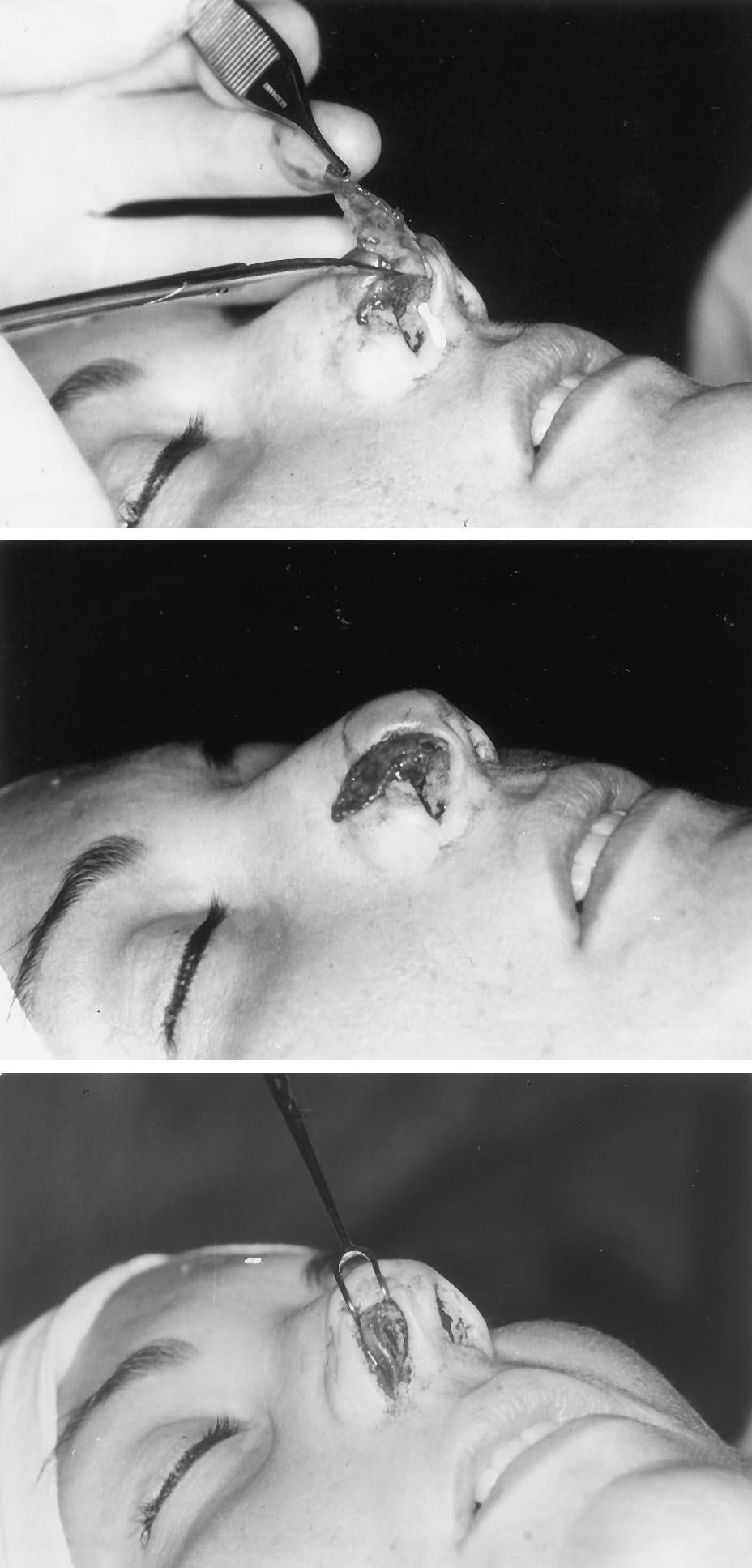 1840 PLASTIC AND RECONSTRUCTIVE SURGERY, April 2000 strated a dramatic picture of malposition (Fig. 21). On front view, the nasal tip was ball-like and bordered by parentheses.