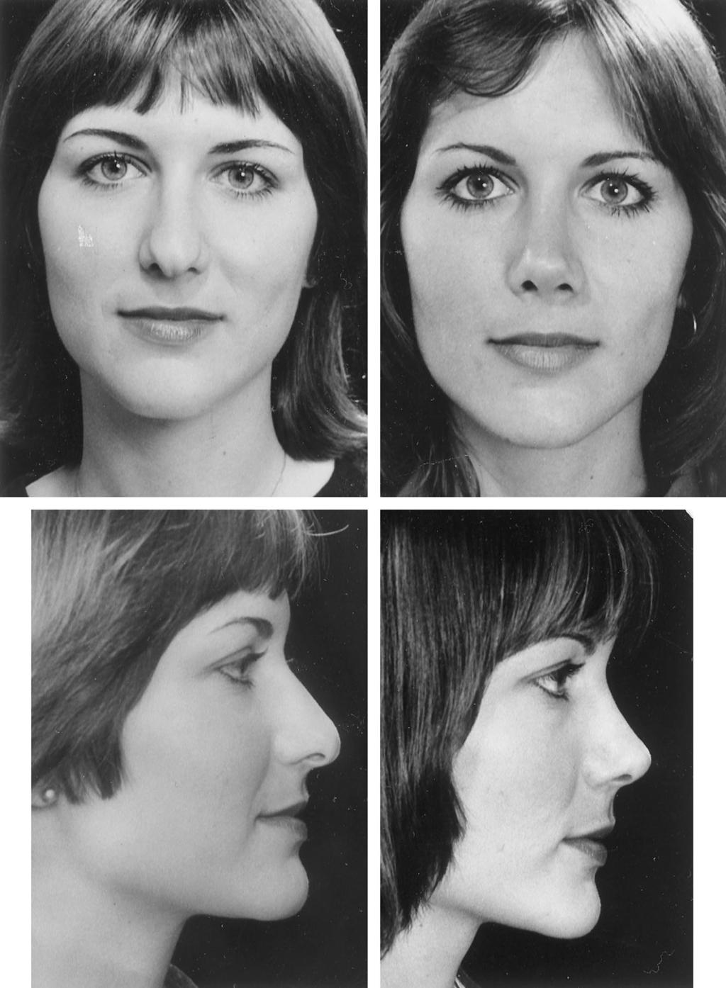 Vol. 105, No. 5 / RHINOPLASTY: PERSONAL EVOLUTION AND MILESTONES 1841 FIG. 23. Patient shown 14 months after surgery with good support to the alar rims and improved tip projection.