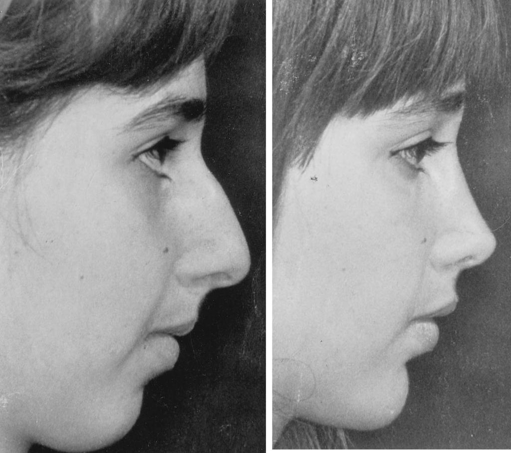 Vol. 105, No. 5 / RHINOPLASTY: PERSONAL EVOLUTION AND MILESTONES 1847 FIG. 29. Patient operated on in 1968. Her alar cartilage configuration was ideal for the standard tip refining technique. VII.