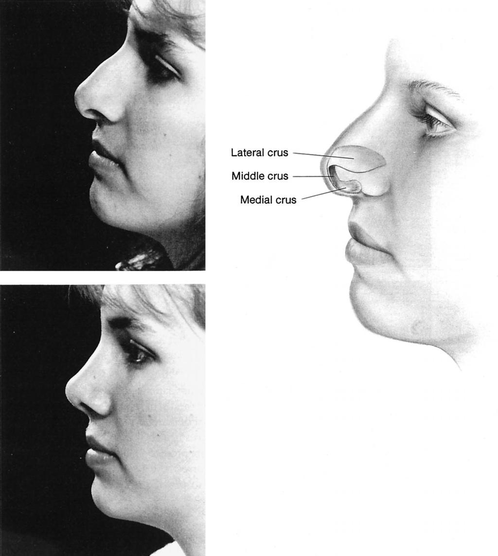 Vol. 105, No. 5 / RHINOPLASTY: PERSONAL EVOLUTION AND MILESTONES 1849 FIG. 33. (Above, left) Square tip reflecting long middle crura with a wide angle of rotation.