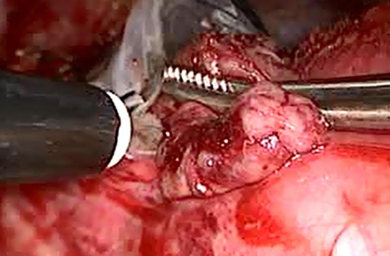Page 4 of 5 Video-Assisted Thoracic Surgery, 2017 Video 3.