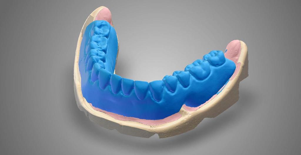 c. Software Workflow For both Basic and Advanced Fixed Bar solutions it is recommended to scan the Denture Wax-Up.
