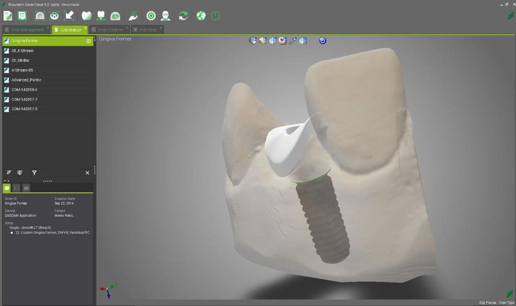 2.2 Gingiva Former A new Prosthesis Subtype called Custom Gingiva Former can be found in the Abutments Family.