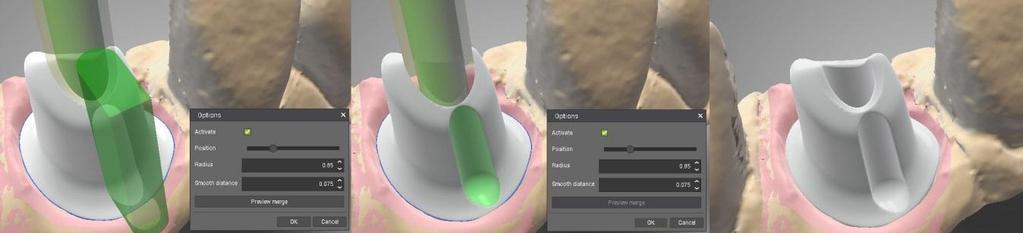 3.3 Customized Abutment Anti-Rotation groove The CARES user can create an Anti-Rotation groove on a Custom Abutment. This can be made by selecting add rotation stop in the abutment local menu.