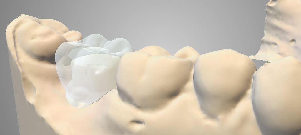 After the codiagnostix partner has set the implants the diagnostic crowns can be switched to any prosthesis