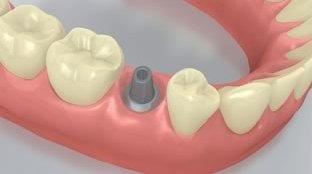 Flowchart IMPLANT - Abutment made of titanium - Crown - Lithium disilicate - Retentive abutment shape - Posterior tooth - 1 Preoperative situation The abutment is screwed in place.