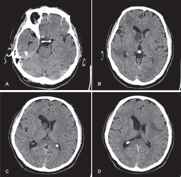 Cerebral CT scan: multiple nodular lesions with aspect of secondary determinations with peripheral iodophilia in the ring and edema of adjacent right white substance located supratentorially (frontal