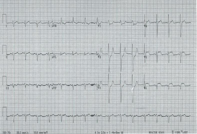 Cardiogenic -Secondary to myocardial infarction 3.