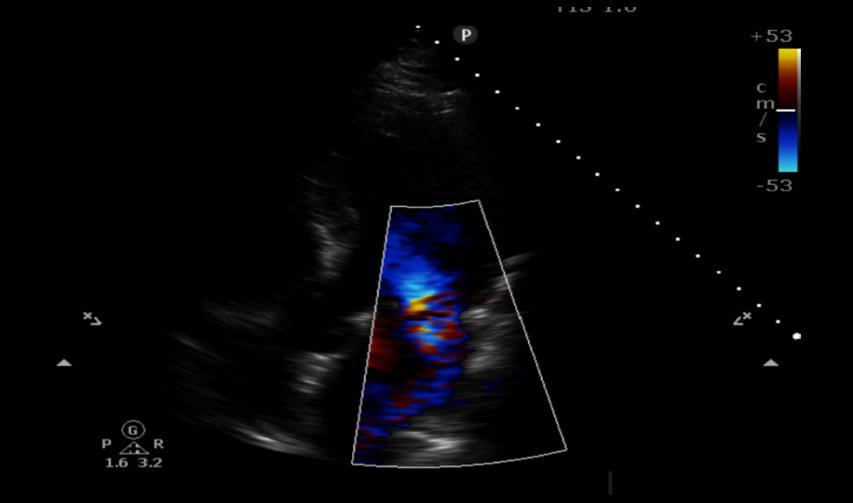 Figure1,2,3: Apical four chamber view of EP performed ECHO showing echogenic mass in the left ventricle (fig 1) with
