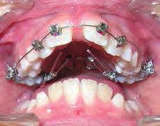 the SWA: During expansion of MAX by 6 to 7 mm, the appliance will push the M1s disto-buccally (DB) and distally, and by