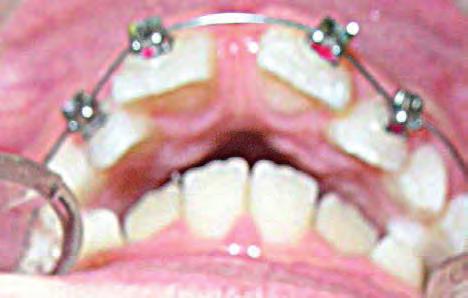 Space is gained for 33 & 43 by the advancement of the incisors: Md1 to A-pog line = -2 mm and Md1 to NB = 3 mm & 21,