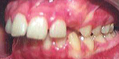 272 Chapter 16 Clinical cases: mixed dentition and adolescent, CLII non-extraction Steep MPA (46 ) Vertical growth pattern