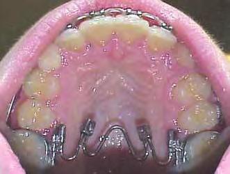 rotated molars. Inter-Molar width = 31 mm.