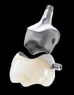 screw retained. Our screw retained implant crowns include lingual and occlusal screw.