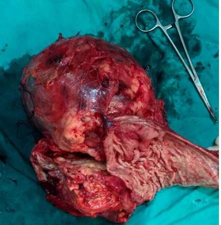 Fig 6: En-bloc excised mass along with spleen, tail of