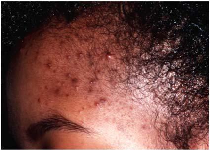 Mild - Moderate Acne 19 year old female Developed lesions aged 15 Used many OTC products which have not helped GP has given her topical treatments which sting and bleach; she has stopped using them