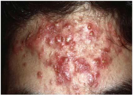 Severe Acne 20 year old man Had acne since the age of 14 years Has been self-conscious about it for 6 months Has had one short course of antibiotics worked initially but when discontinued came back