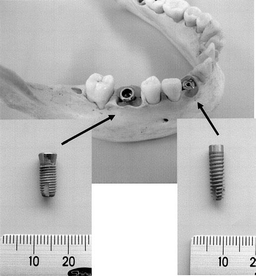 Implant Length Measurement on Radiographs 107 Fig. 1 Objects used to obtain sample images with each imaging modality imaging modality, including PE and PA radiography, CV and medical CT tomography.