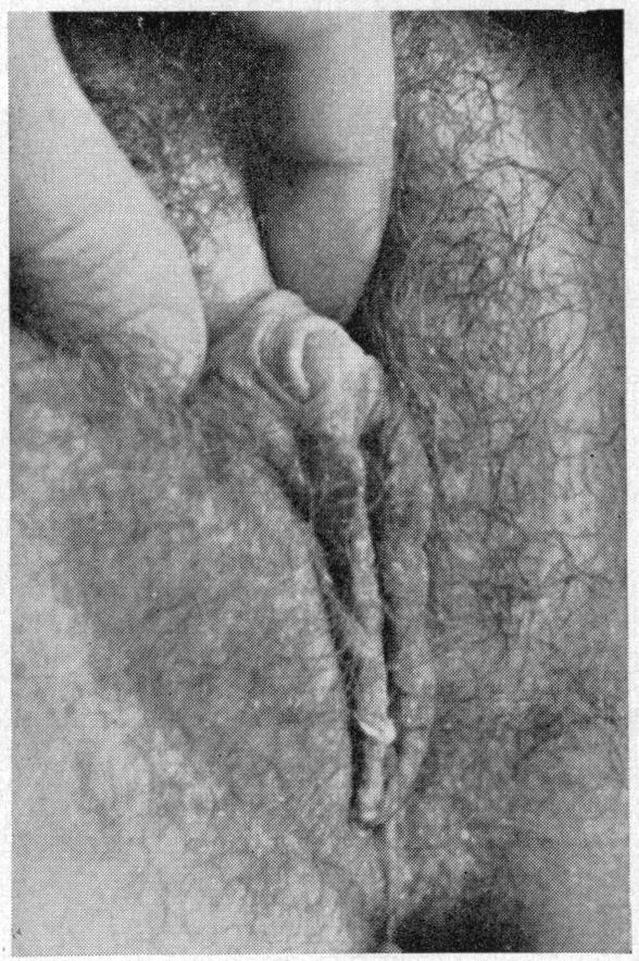 Her height was 175 cm, her body proportions were eunuchoidal with prepubertal type of breast and scanty axillo-pubic hair. The clitoris was somewhat hypertrophied (Figs.