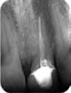 The socket is covered by a thin layer of newly-formed soft tissues. 7 I Periapical radiograph four weeks after extraction.