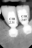 96 L. Gaxho et al. Balk J Dent Med, Vol 20, 2016 implants (15.2%) by two implants and 20 implants (30.3 %) were adjacent by one tooth/one implant.