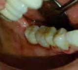 The other failed implant was placed in the posterior mandible in a non-smoker patient. It failed after insertion of the Integrated Abutment Crown and was no longer replaced.