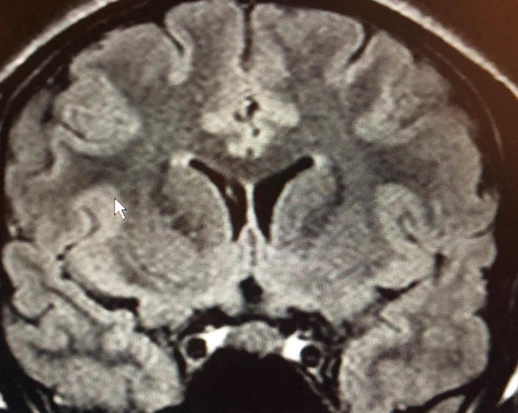 POTS or CSF Leak? Just one patient treated this month Never has headache in the morning.
