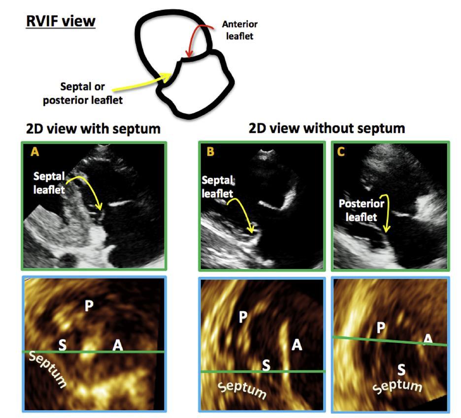Tricuspid Leaflets on 2D Echo
