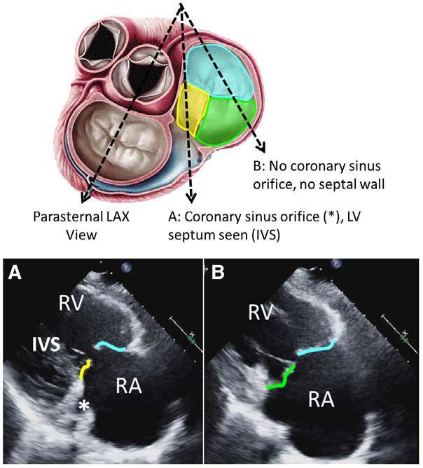 Tricuspid Leaflets on 2D Echo Hahn RT,