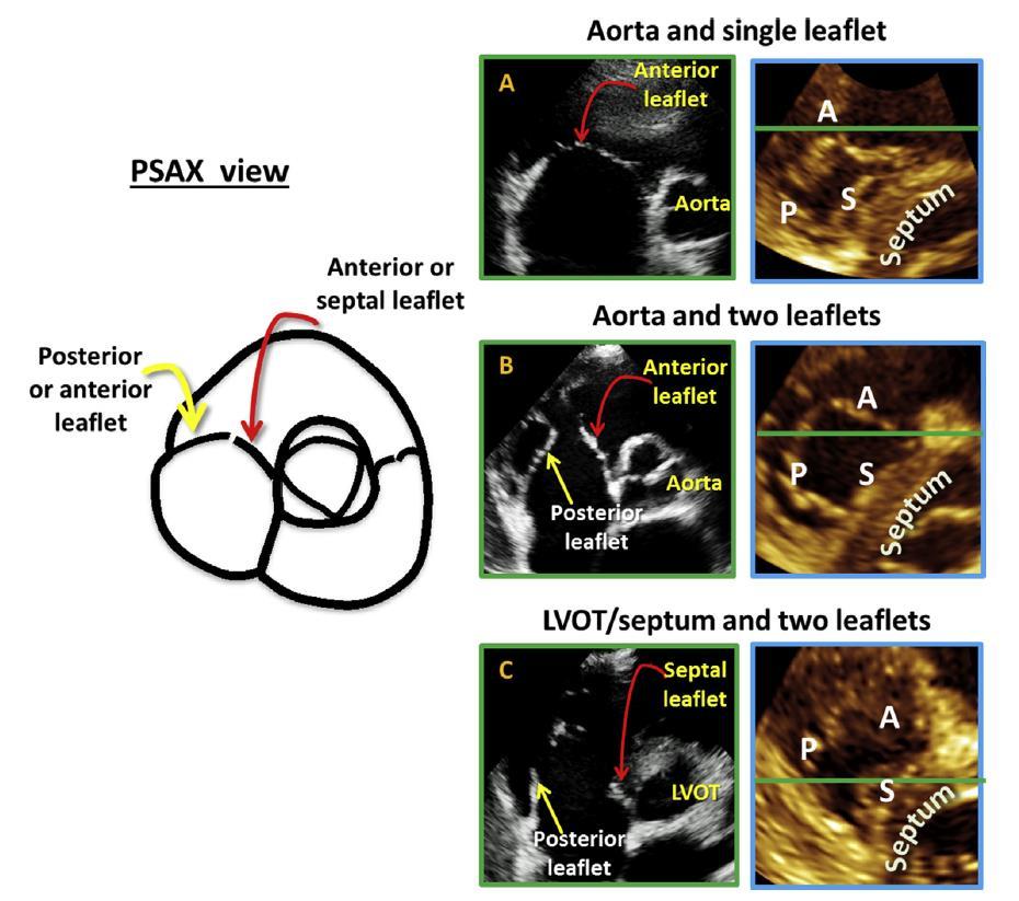 Tricuspid Leaflets on 2D Echo
