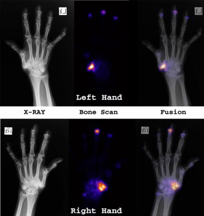 Figure 1 Figure 1: A 72 year old female with a history of osteoarthritis in both hands and a past history of melanoma. A three phase bone scan was performed of the wrists and hands.