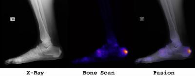 The bone scan demonstrated increased vascularity with moderate periarticular activity in the right first and second MTP joints and at the right second/third tarsometatarsal joints and proximal