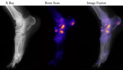 The three phase bone scan showed increased vascularity at posterior left plantar fascia corresponding to delayed images showing activity at left calcaneal plantar fascia insertion (plantar fasciitis).