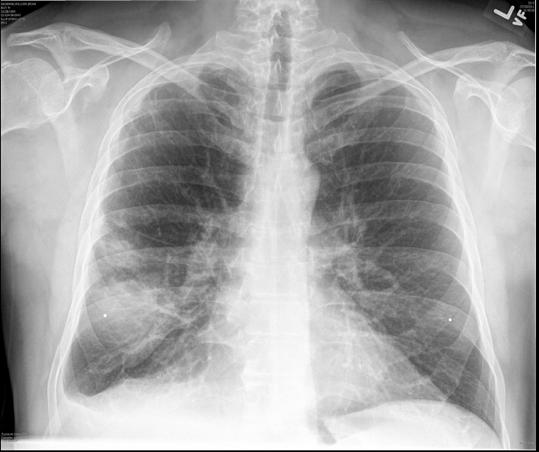 Dilemma #1: Use of Immunomodulatory Agents 51 yo male presents with 10-14 d of cough, SOB, fever, anorexia PMH: Htn, Gout, EtOH abuse PE: T=101.1, 115/72, 83% on RA Crackles in R mid lung WBC=13.