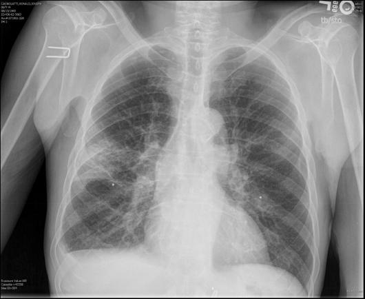 Dilemma #2: Duration of Treatment How long should patients be treated for CAP? Case: 57 yo male with malaise, dry cough, and altered mental status.