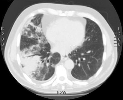 risk of lung cancer (diff study in male veterans found 5 years incidence of 9.