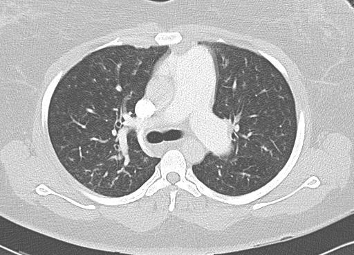 HRCT confirms an enlarged pulmonary artery: