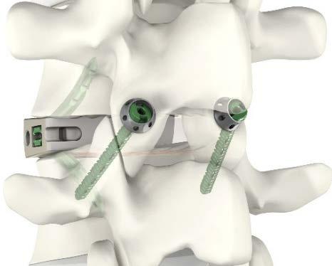 MIVo Lumbar Fusion Surgery A New Philosophy Extending the benefits of VerteBRIDGE to new applications in the lumbar