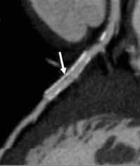 (Courtesy of James Earls, MD.) A B C D Figure 3. Stent patency is assessable in cases where stent diameter is 3 mm and heart rate, noise, and window/level are optimized.