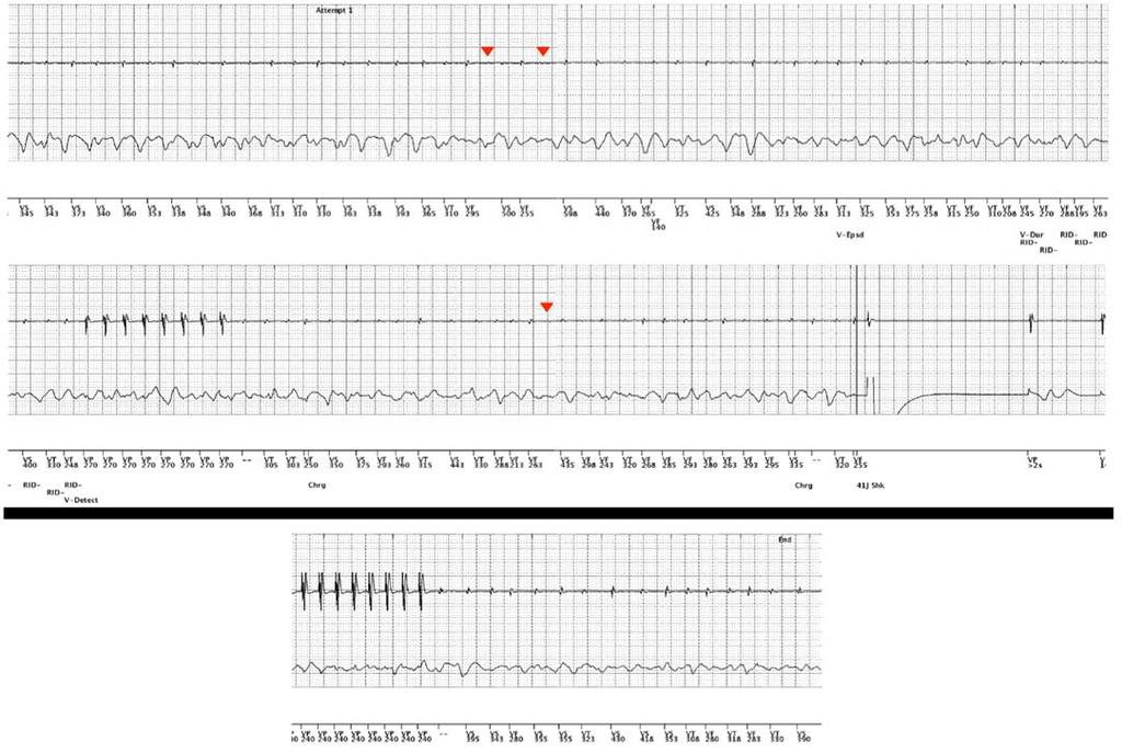 efigure 9 (Case 20). Top and Middle Strips (continuous): Extended VF event with undersensing (arrowheads) that delays therapy. In addition, ATP delays shock therapy.