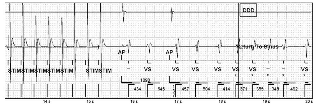 efigure 10 (Case 21). Top: atrial electrogram. Middle: ventricular electrogram. Bottom: device markers.