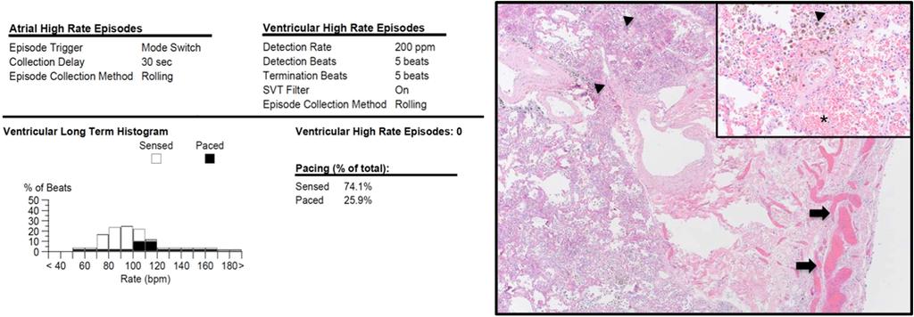 efigure 1 (Case 5). Left: Post mortem device interrogation showing no ventricular high rate episodes. Right: H&E section of lung (12.