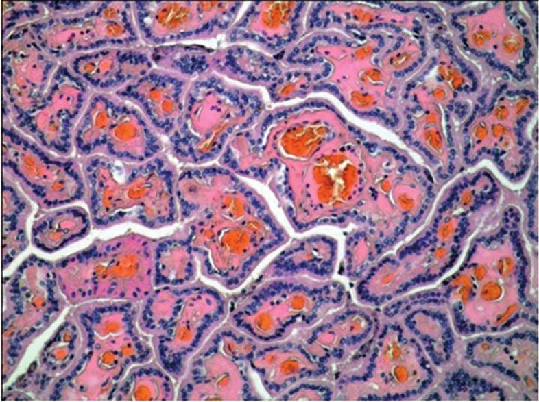 Fig. 2. Microscopic view: papillary architecture with hyalinized stroma lined by a single layer of columnar cells with isomorphic nuclei and a moderate amount of cytoplasm.