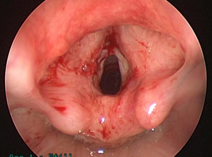 Variety of tools (laser, microdebrider, etc) Complications Stenosis,