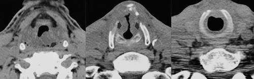 A B C Fig. 2. Bilateral transglottic laryngeal carcinoma.