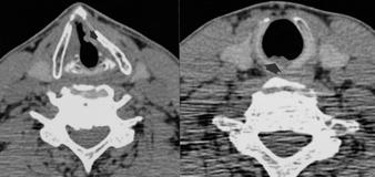 Fig. 3. Right transglottic cancer with right vocal cord palsy. A.