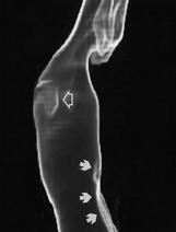 AP CT laryngogram during Valsalva maneuver reveals incomplete occlusion of the glottis (arrow). A B A B C Fig. 4.