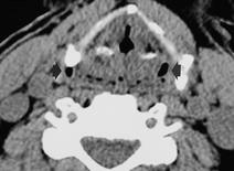 A B C Fig. 5. A 57-year-old man with right pyriform sinus cancer affecting the apex.