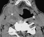 Normal pyriform sinus is expended and aerated on modified Valsalva maneuvers (C). A B C Fig. 6.