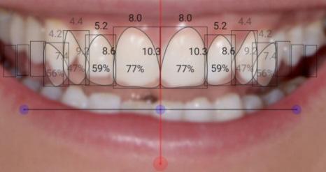 Type the width of the incisor.